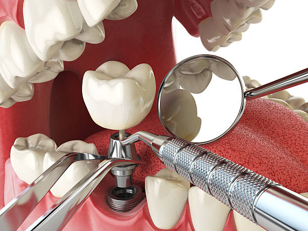 Best Emergency Broken Tooth Repair in Cockeysville, MD